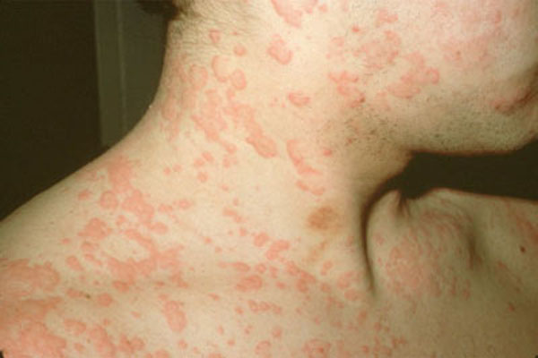 Bệnh viêm da dị ứng có lây không?