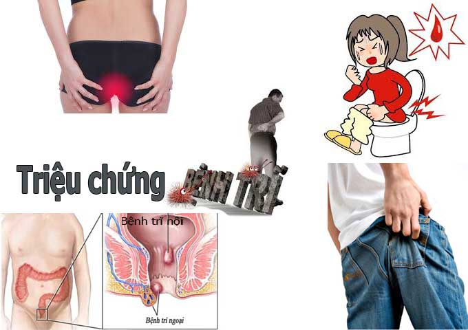 Điều trị căn bệnh trĩ hiện nay như thế nào?