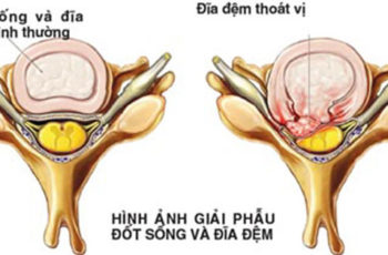 Những giai đoạn thoát vị đĩa đệm