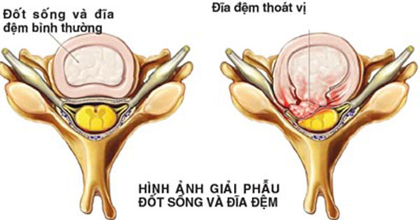Những giai đoạn của bệnh thoát vị đĩa đệm