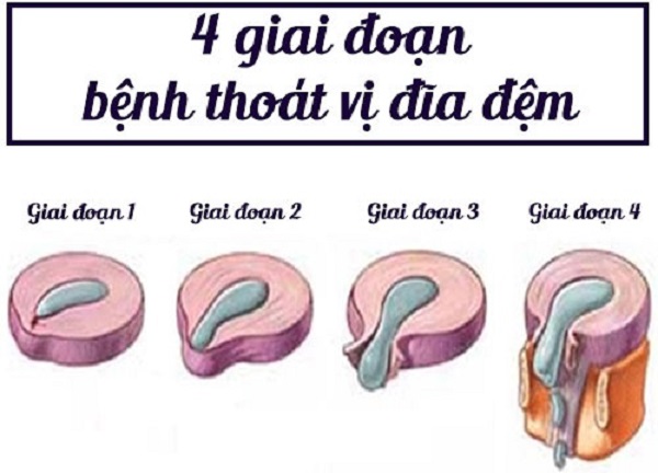 Những giai đoạn thoát vị đĩa đệm