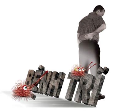 Các bài thuốc chữa trị bệnh trĩ ngoại đơn giản