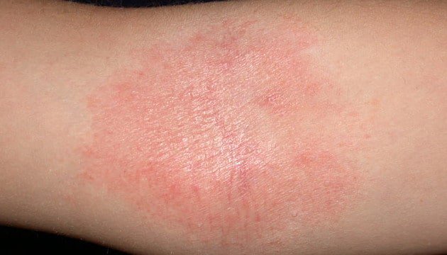 Nguyên nhân cơ bản gây bệnh chàm khô