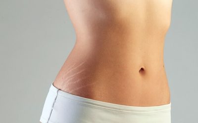 Chia sẻ thông tin về rạn da trong giai đoạn dậy thì